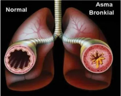 Gambar 2.1. Normal dan Asma Bronkial 11 