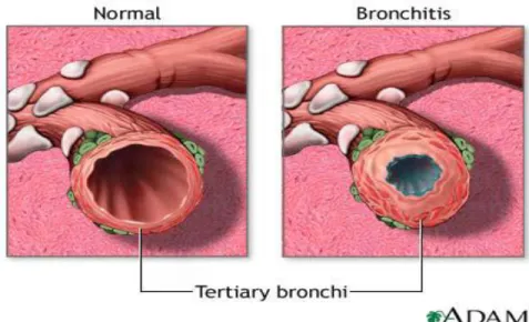 Gambar 2.1 Gambaran bronki normal dengan dengan bronkitis 