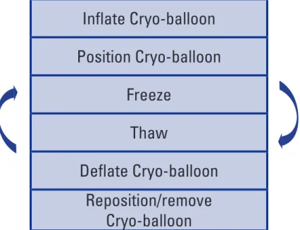 Figure 10.  Inflate Cryo-balloon Position Cryo-balloonFreezeThawDeflate Cryo-balloonReposition/remove Cryo-balloon