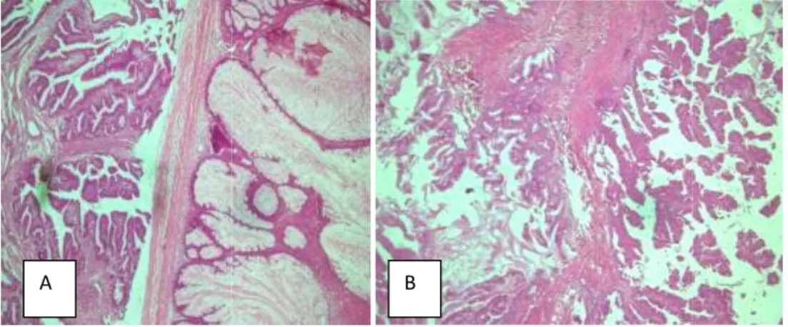 Gambar  2.  A  dan  B.  Sel  epitel  ganas  terdiri  dari  campuran  sel  serus  dan  sel  musinus tipe endoservikal 