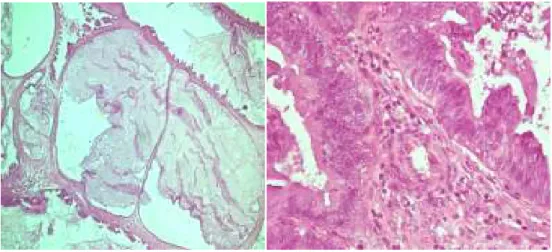 Gambar 5. A. Genangan musin ekstraseluler B. Stroma mengandung sebukan sel  radang PMN netrofil, limfosit dan sel plasma.