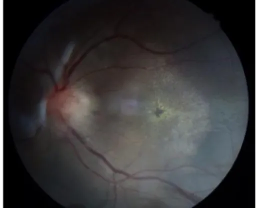 Gambar 2 Funduskopi mata kiri memperlihatkan edema papil nervus optik disertai macular star  pada follow up hari keempat