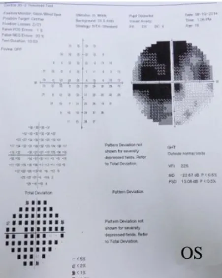 Gambar 4 Hasil pemeriksaan perimetri memperlihatkan skotoma sentral luas pada mata kiri