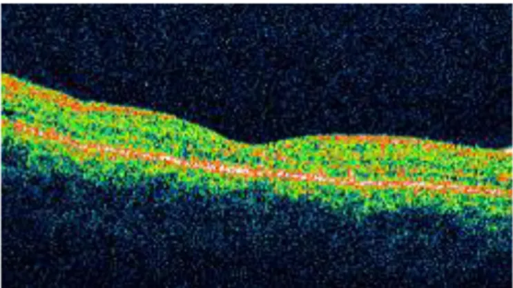 Gambar 5 Pemeriksaan OCT menunjukkan reduksi ablasio makula serosa pada follow up  minggu ketiga dan penurunan ketebalan fovea menjadi 206 m