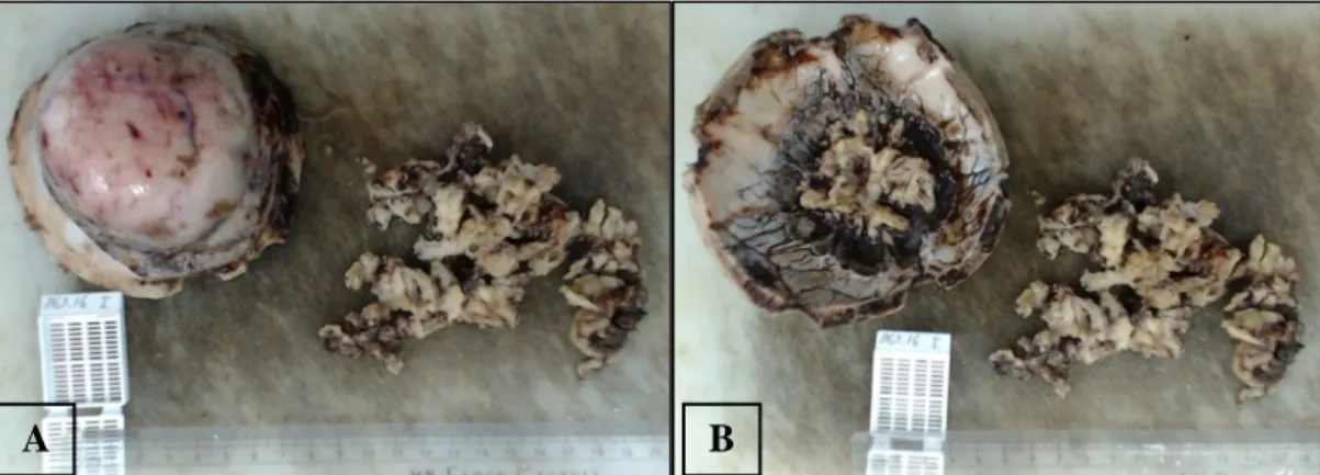 Gambar  3.  Bahan  makroskopis  :  (A)  permukaan  luar,  (B)  permukaan  dalam  tulang tengkorak disertai potongan-potongan massa tumor.
