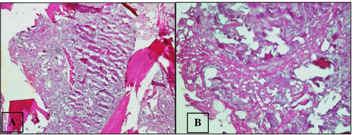 Gambar 7.(A 100x, B 400x).Jaringan tulang tersusun atas matriks tulang dan jaringan hematopoietik, mengandung infiltrasi sel-sel ganas.