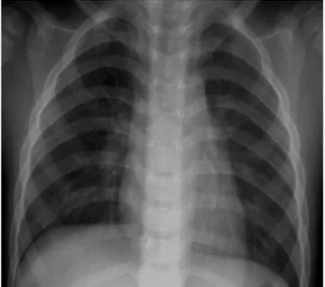 Gambar 5. Foto thorax PA normal (anak). Identitas dan nomor foto tidak ditampilkan 