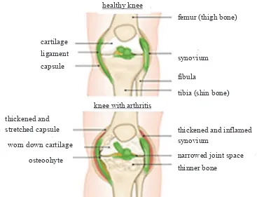 Figure 2.1: Comparison between a healthy knee and knee with osteoarthritis.