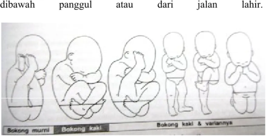 Gambar 2.2 klasifikasi presentasi bokong Sumber : Prawirohardjo (2011) d. Patofisiologi