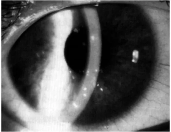 Gambar 2.2. Keratitis Pungtata  Sumber: Thygeson (1950) 