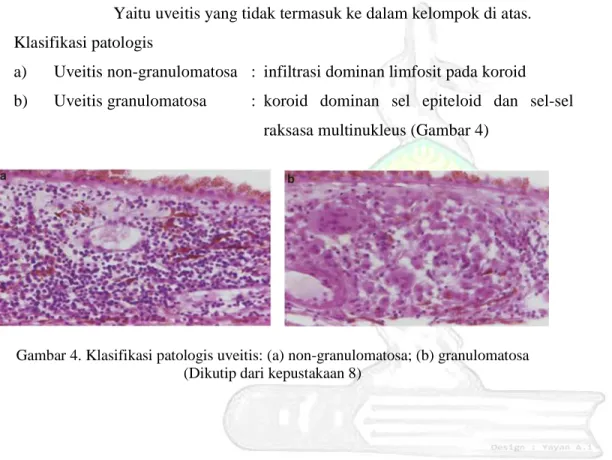 Gambar 4. Klasifikasi patologis uveitis: (a) non-granulomatosa; (b) granulomatosa  (Dikutip dari kepustakaan 8) 