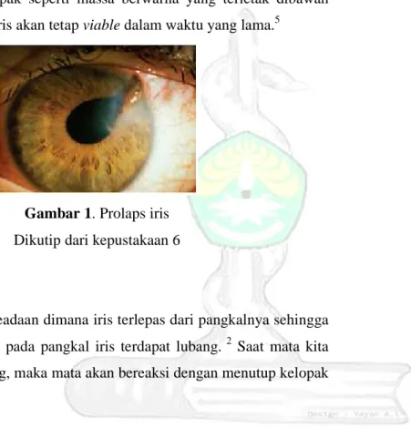 Gambar 1. Prolaps iris  Dikutip dari kepustakaan 6 