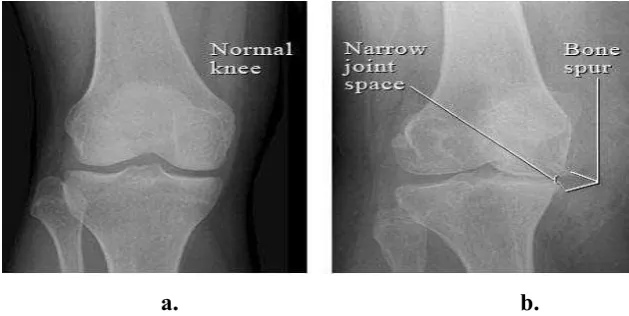 Figure 2.2: Examples of image of knee joint by X-rays. a) Normal knee b) bone 