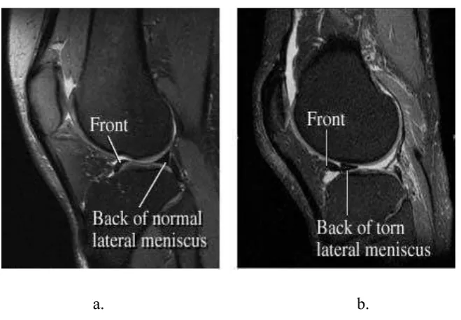 Figure 2.3: Examples of image of knee joint by MRI. a) side view of the normal 