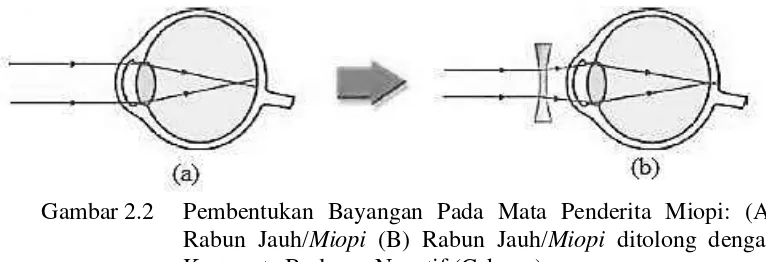Gambar 2.2  Pembentukan Bayangan Pada Mata Penderita Miopi: (A)  Rabun Jauh/Miopi (B) Rabun Jauh/Miopi ditolong dengan Kacamata Berlensa Negatif (Cekung) 