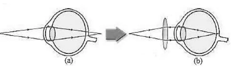 Gambar 2.3 Pembentukan Bayangan Pada Mata Penderita Hipermetropi: (a) Rabun Dekat / Hipermetropi  (b) Rabun Dekat/Hipermetropi ditolong dengan Kacamata Berlensa Positif (Cembung) 