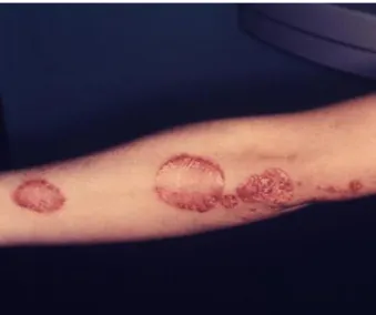 Gambar  Psoriasis pada lengan 