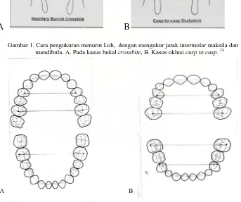 Gambar 2. A. Pengukuran menurut Rakosi A. gigi permanen, B. gigi susu.20