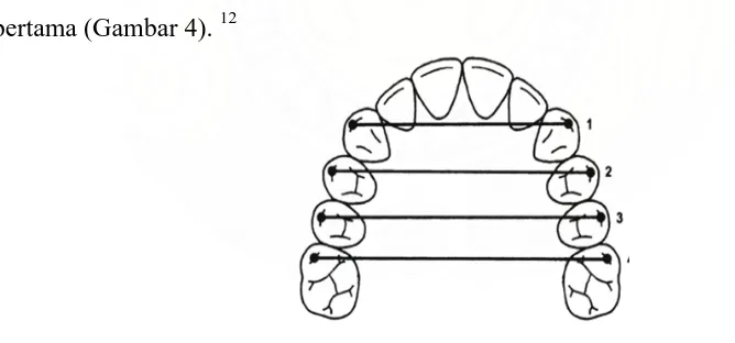 Gambar 3. Pengukuran menurut Lux, hanya dilakukan  pada daerah intermolar maksila ( A )                   dan mandibula ( B ).14  