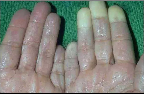 Figure 1.1: Hand-arm vibration syndrome 