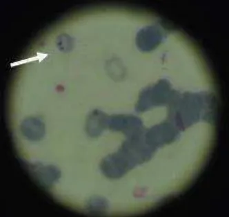 gambar tampak inti parasit berwarna merah, sitoplasma yang berwarna biru keunguan dan tampak pigmen coklat kehitaman, ditemukan juga bentuk double kromatin