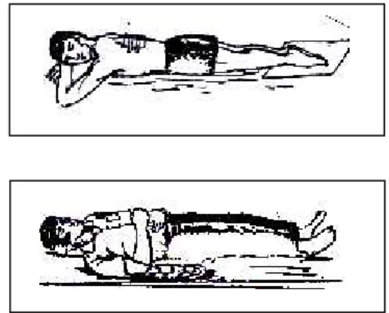Gambar 4-14 - Cara pertolongan penderita patah tulang belakang 1. Bila ada luka 2. Bila tidak luka