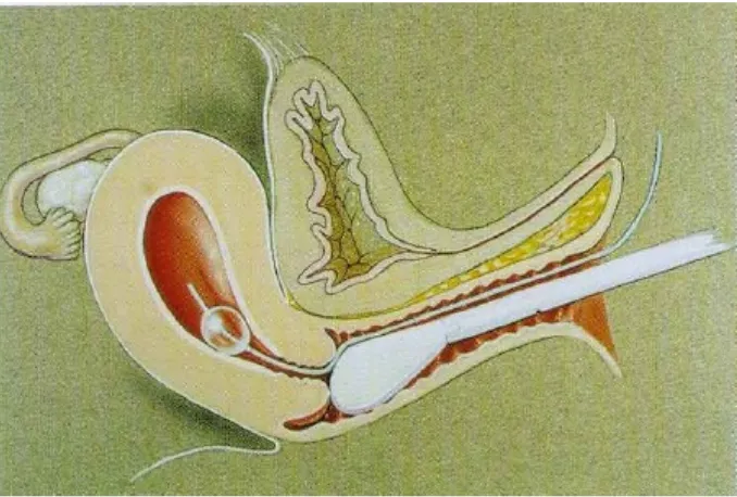 Gambar 7. Color Signals (tanda panah putih) melalui tuba Falopii ke ronggaperitoneum yang menunjukkan tuba paten