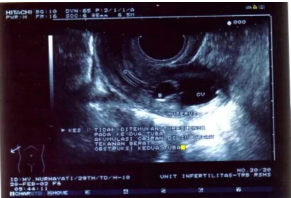 Gambar 8. Pada kasus obstruksi tuba tidak ditemukan turbulensi pada kedua tuba,tekanan cairan dirasakan sangat berat dan terdapat peregangan cavum uteri.
