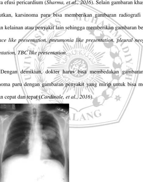 Gambar 1 Gambaran karsinoma paru pada pemeriksaan foto polos thorax 