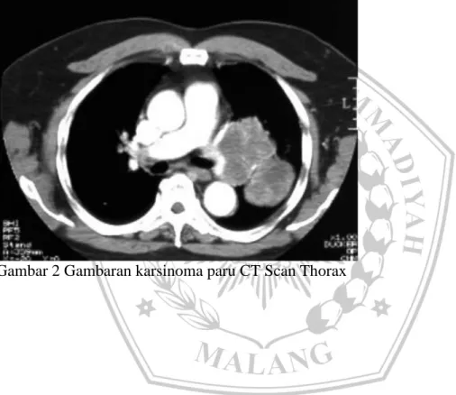 Gambar 2 Gambaran karsinoma paru CT Scan Thorax 