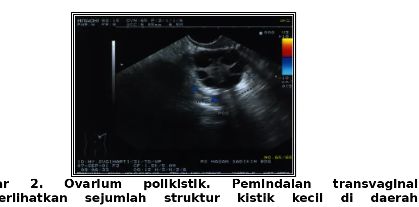 Gambar  2.  Ovarium  polikistik.  Pemindaian  transvaginalmemperlihatkan  sejumlah  struktur  kistik  kecil  di  daerahpermukaan dan gambaran hiperekogenik di stroma ovarium