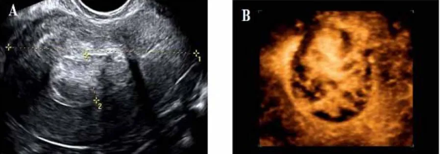 Gambar 3a & 3b. Wanita 40 tahun dengan mioma uteri. Potongan transversal dengan USG-TV menunjukkan mioma uteri (kaliper) namun letak pastinya tidak jelas karena bagianposterior tidak dapat diidentifikasi (Gambar 3a)