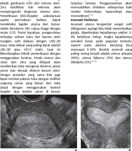Gambar 4a & 4b. Wanita 31 tahun dengan infertilitas. Potongan transversal uterus tidaktampak kelainan (4a)