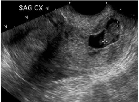 Gambar 11. Kehamilan servikal. Tampak kantong kehamilan berisifetus yang berimplantasi di kanalis servikalis