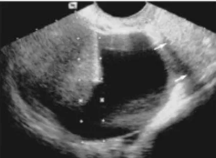 Gambar 3. Pungsi dan aspirasi kista ovarium. Jarum menembusdinding kista sesuai dengan arah tuntunan (guide) yang tampakberupa garis di layar monitor