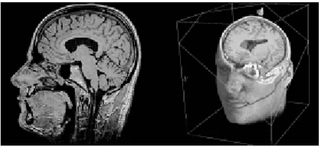Gambar 1. Contoh Hasil CT Scan Pada Kepala  Manusia. Gambar  Irisan Samping (Kiri) dan 