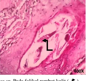 Gambar 6. Terlihat adanya potongan Demodex sp. Pada folikel rambut kulit (      ). 