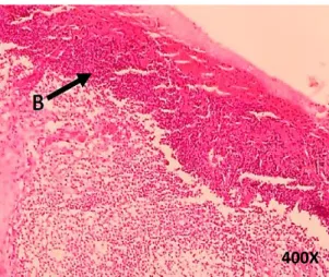 Gambar 8. Infiltrasi sel radang pada stratum korneum (A) dan stratum spinosum (B). 