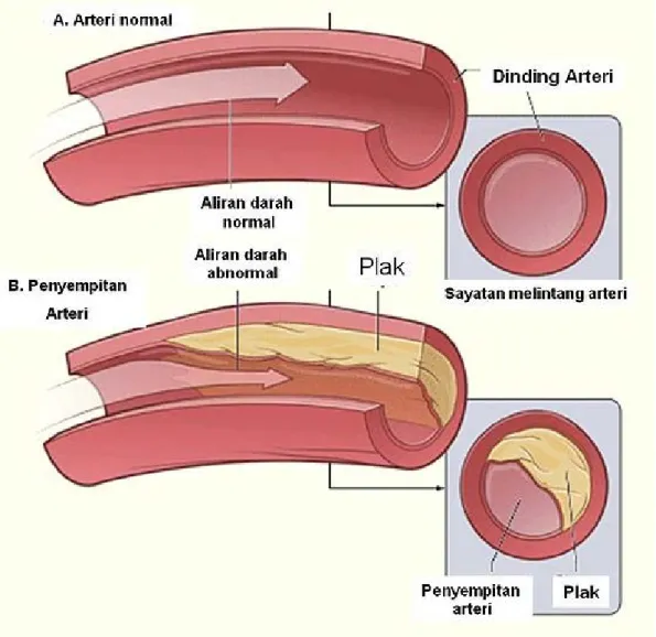 Gambar 2.7 Diagram Aterosklerosis 