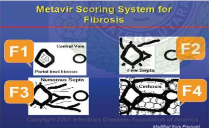 Gambar 2.14 Skor Metavir Pada Fibrosis Hati (Beddosa, 2007) 