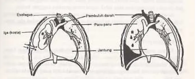 Gambar 4. Kiri, menunjukkan robeknya pleura karena tertusuk patahan tulang iga (pneumothoraks)