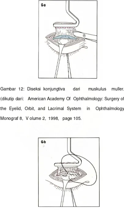 Gambar 12: Diseksi konjungtiva   dari   muskulus  muller.  