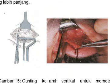 Gambar 15: Gunting    ke  arah   vertikal    untuk    memotong    