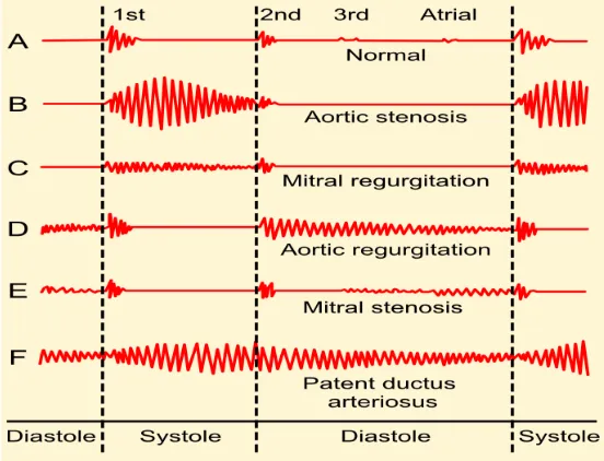 Gambar 2.3. Ragam gelombang suara jantung normal dan abnormal (Wikipedia, 