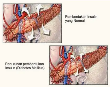 Gambar 1 Sekresi insulin  (Anonim 2007a) 