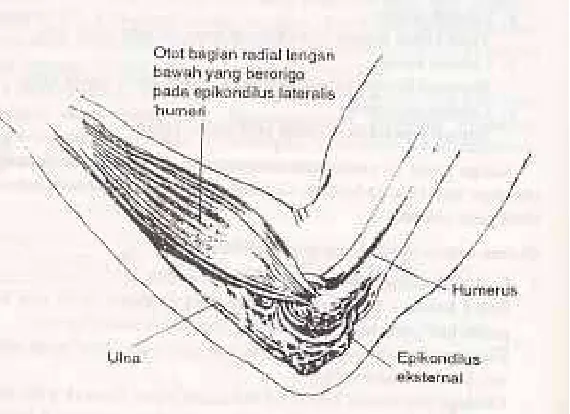 Gambar 4. Tennis elbow  