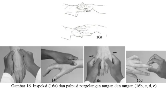 Gambar 17a. Deformitas jari, kiri ke kanan :Mallet deformity, swan neck, Boutoniere deformity,  A:Heberden’s node B:Bouchard’s node 