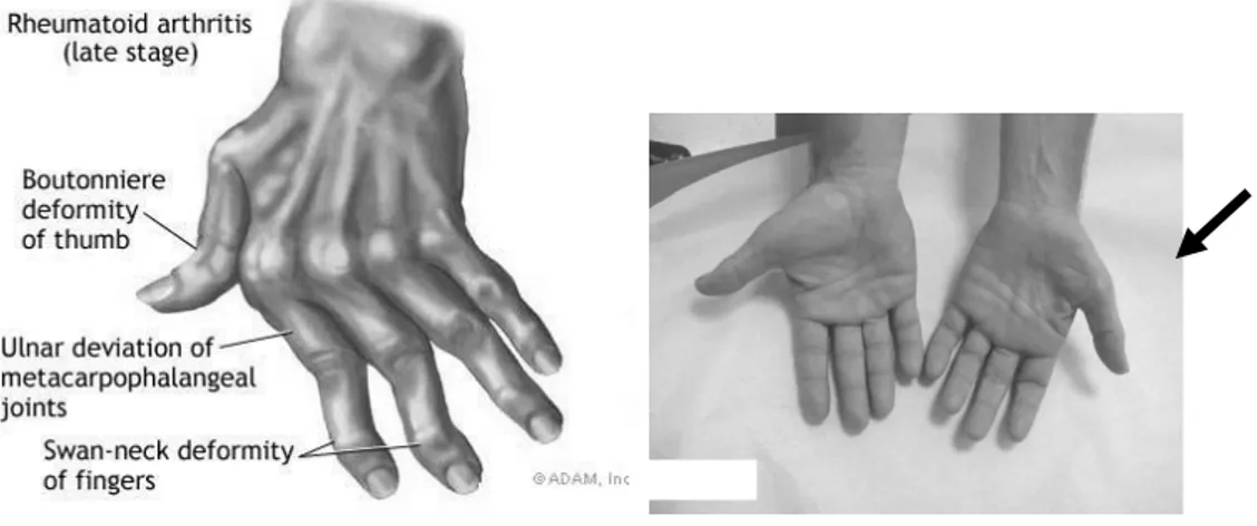 Gambar 19. Kiri : pronasi(normal : 0 - 75 o ); kanan : supinasi (normal : 0 - 80 o ) Gambar 17c
