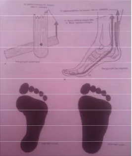 Gambar 7. Kaki sebagai pengungkit sederhana dan diperlihatkan juga jejak kaki  normal dan kaki datar