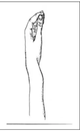 Gambar 3.8 Dinner fork deformity